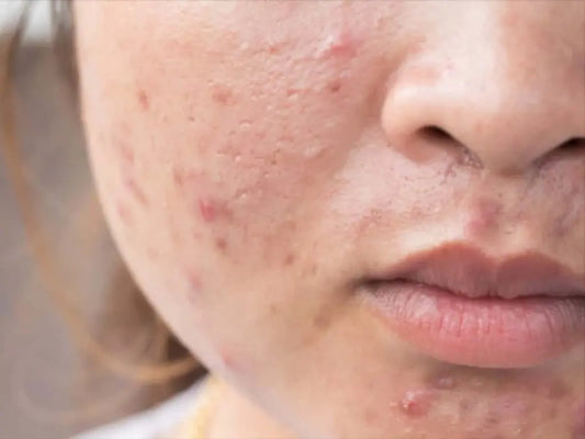 8-Tips-to-Prevent-Acne-Caused-by-Face-Masks-Maskne Mother Earth Natural Health